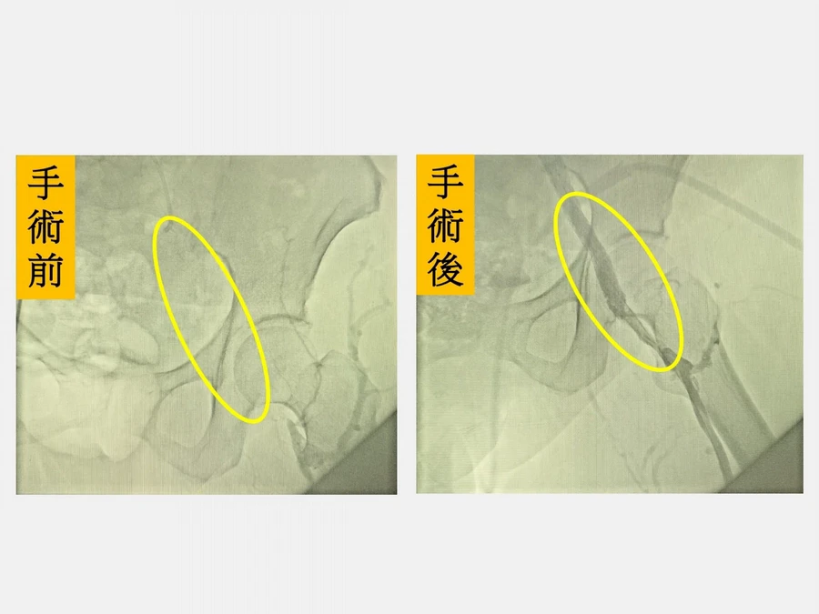 症狀輕微先採保守治療