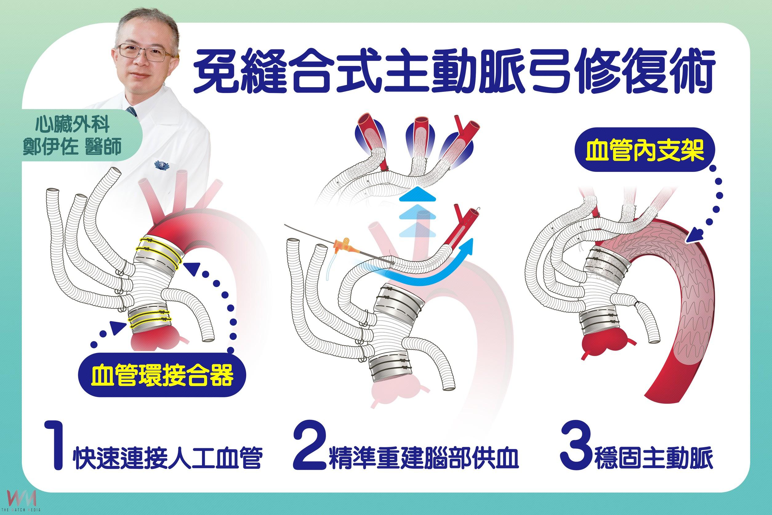 臺灣之光!免縫合式主動脈弓混合型手術 台中慈濟醫院獲亞洲首獎 - https://www.watchmedia01.com