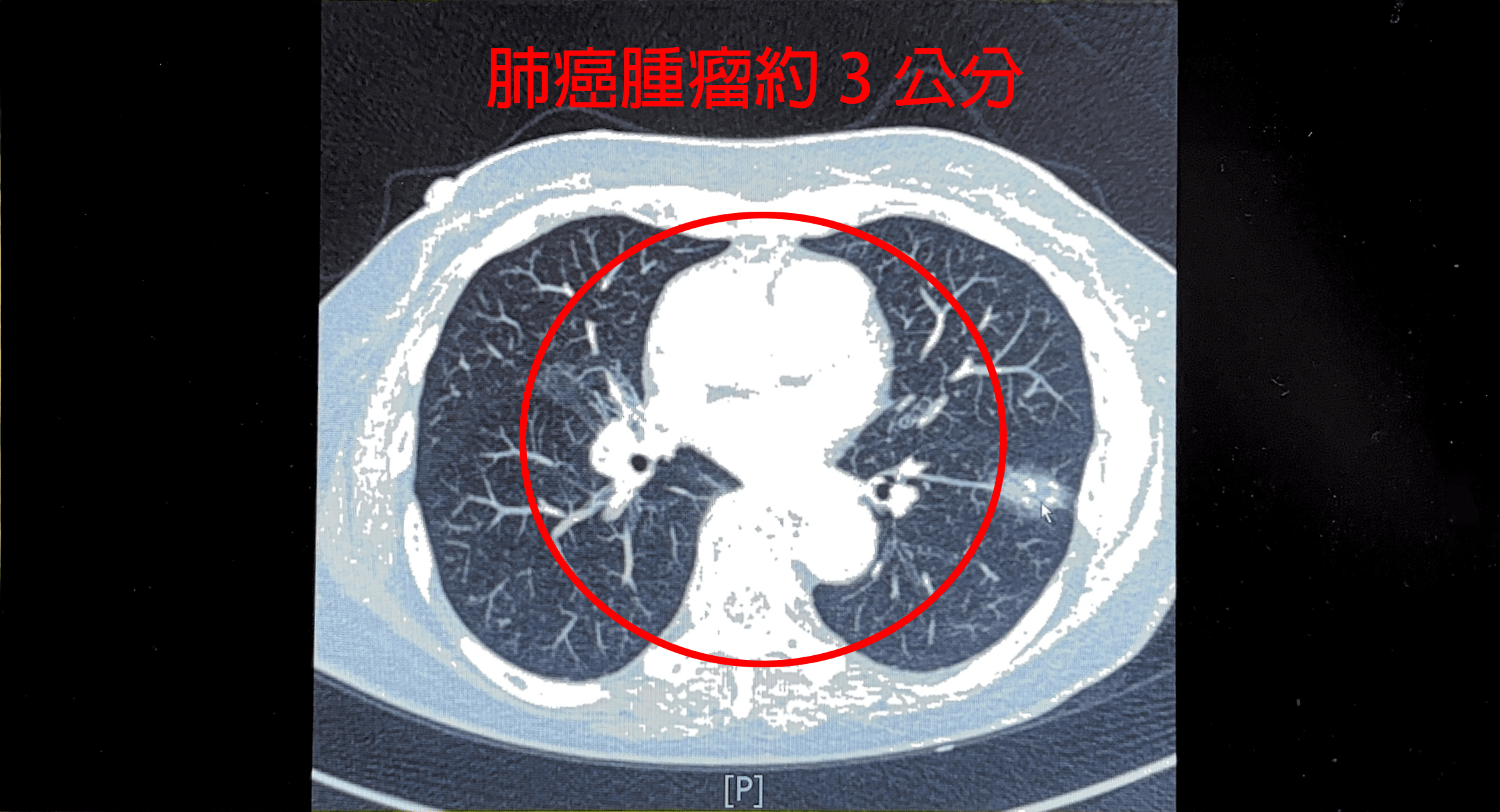 婦人不菸不酒仍患肺癌 中醫大新竹附醫:這情況得到機率恐多200倍 13545