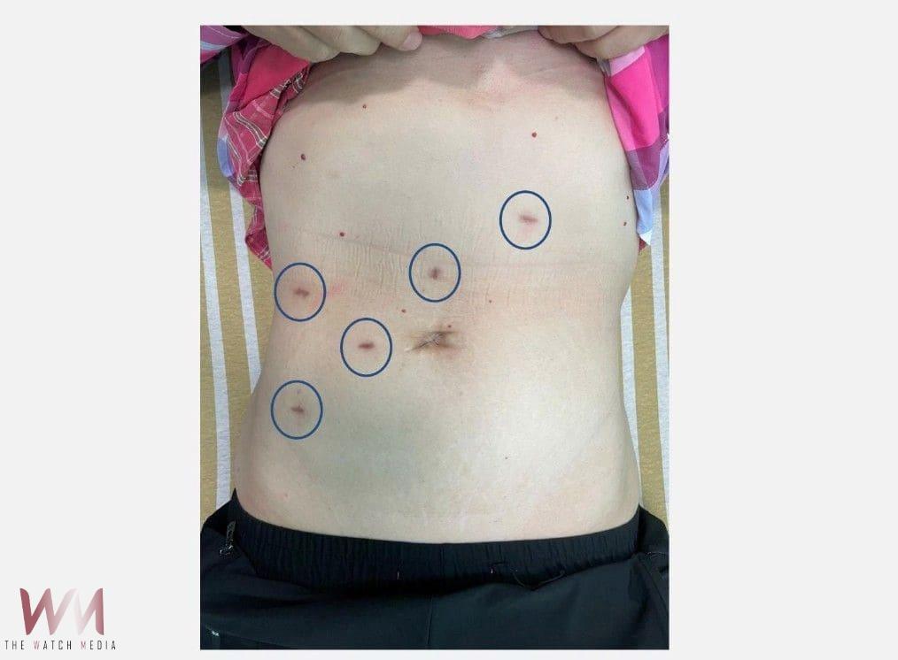 6旬婦陪夫健檢意外發現大腸癌　達文西自然孔手術切除 - https://www.watchmedia01.com