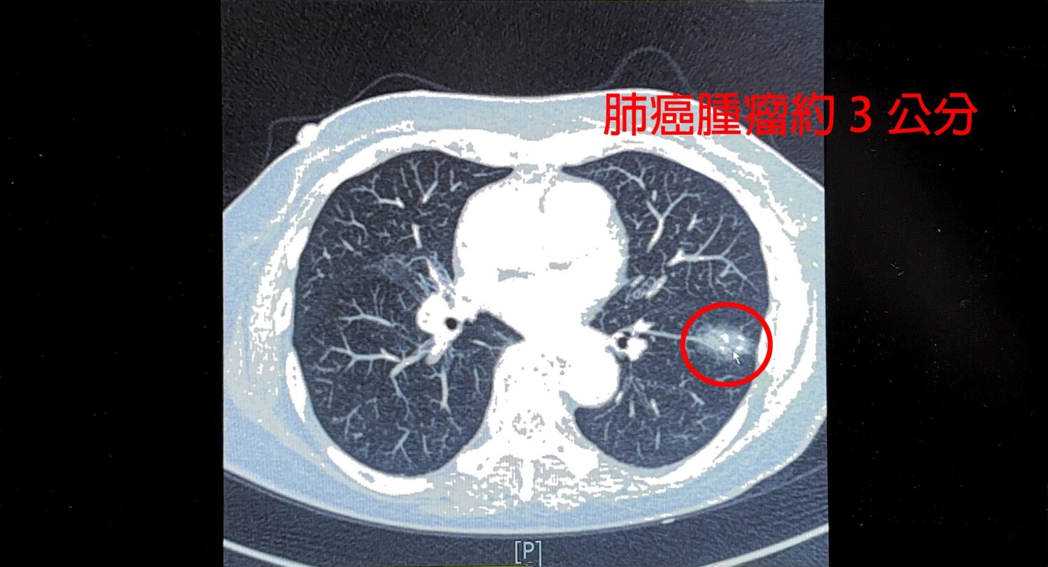 75歲女性患者健檢時發現左下肺葉約3公分腫瘤,經達文西微創手術切除。(圖/記者張家燁翻攝)