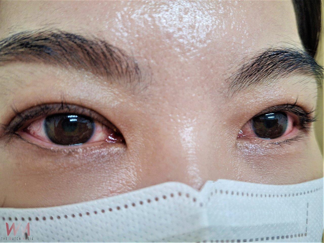 眼睛紅腫、癢、灼熱感、流淚 莫將急性結膜炎誤認是過敏 - https://www.watchmedia01.com