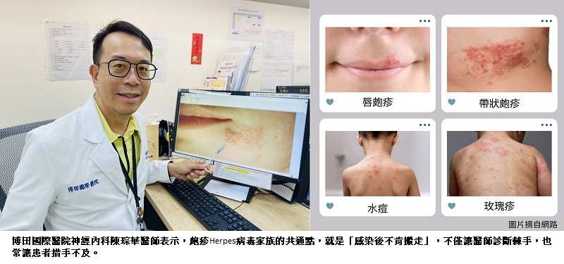 從唇皰疹到玫瑰疹  小水皰背後的大麻煩