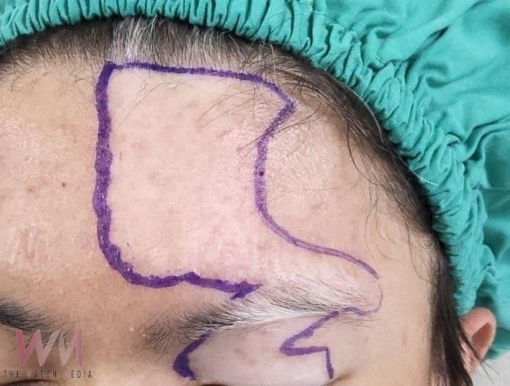 20歲少年戴帽兩年 同儕異樣眼光讓他「不敢抬頭」 醫生助恢復自信 - https://www.watchmedia01.com