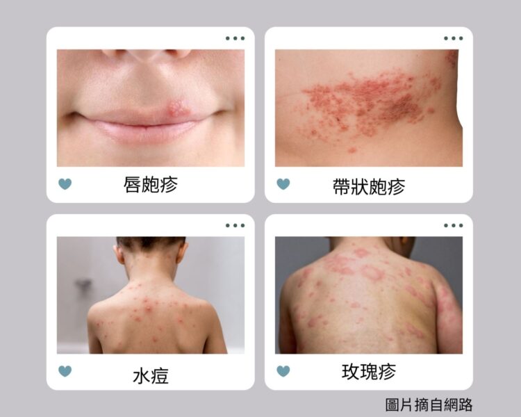 從唇皰疹到玫瑰疹，小水皰背後的大麻煩
