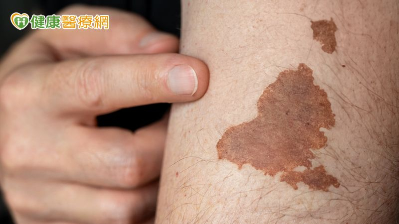 常誤以為只是痣!醫揭「最常見皮膚癌」警訊 這時應立即就醫