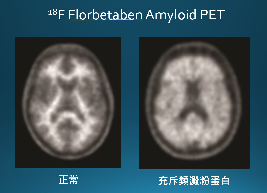 ▲類澱粉蛋白正子造影檢查,圖左為正常的大腦影像,圖右顯示腦內充斥類澱粉蛋白。