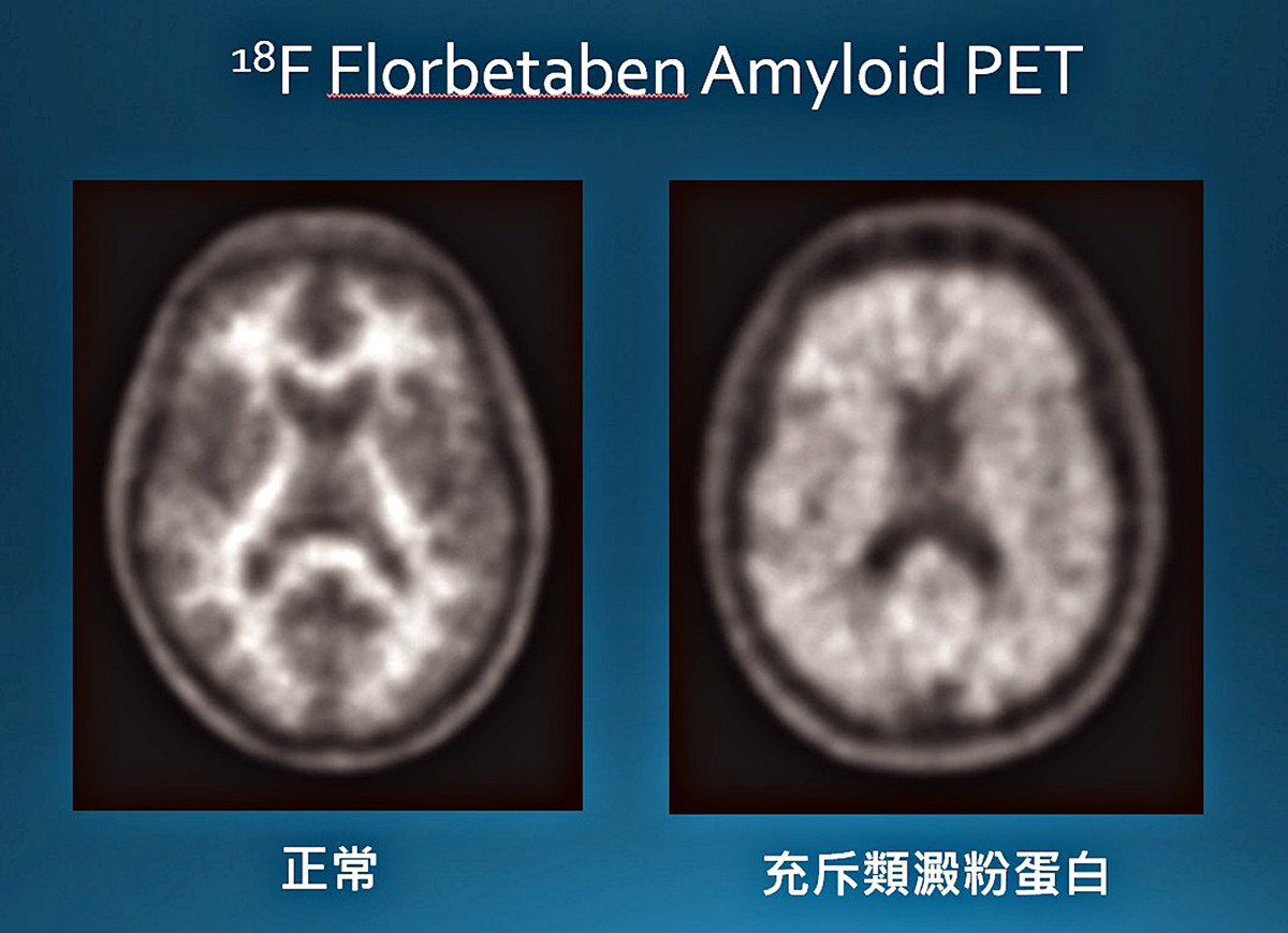 類澱粉蛋白正子造影檢查,圖左為正常的大腦影像,圖右顯示腦內充斥類澱粉蛋白