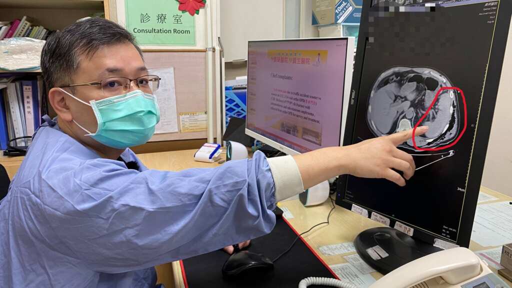 ▲員榮醫療體系員榮醫院急診室翁聖富醫師解釋,張姓患者脾臟(圖中紅圈)破裂的情況。(員榮醫院提供)