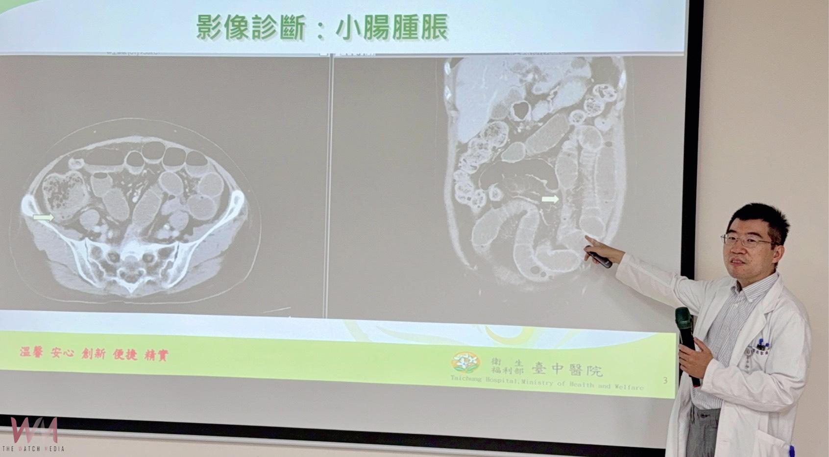 烤肉未熟惹禍 發燒吐拉整晚 醫:秋節後腸胃不適患者增加約兩成 - https://www.watchmedia01.com