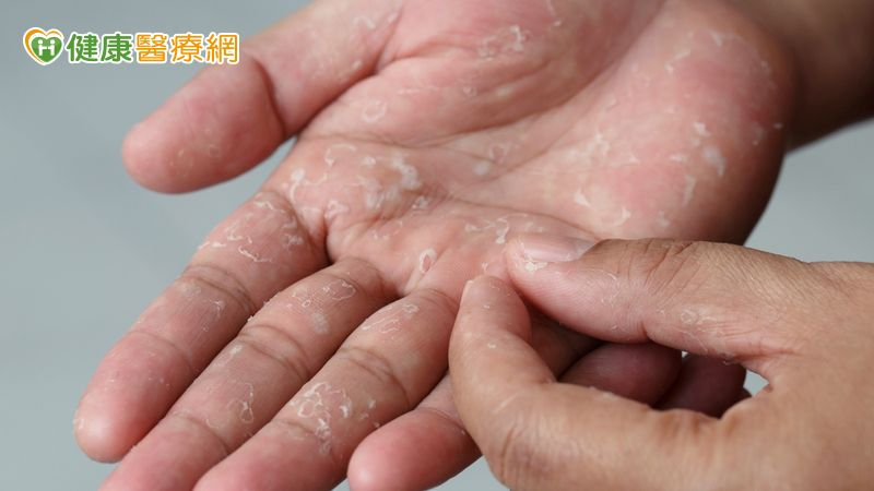 汗皰疹起水泡癢到無法工作　中醫分型調理體質助重返崗位