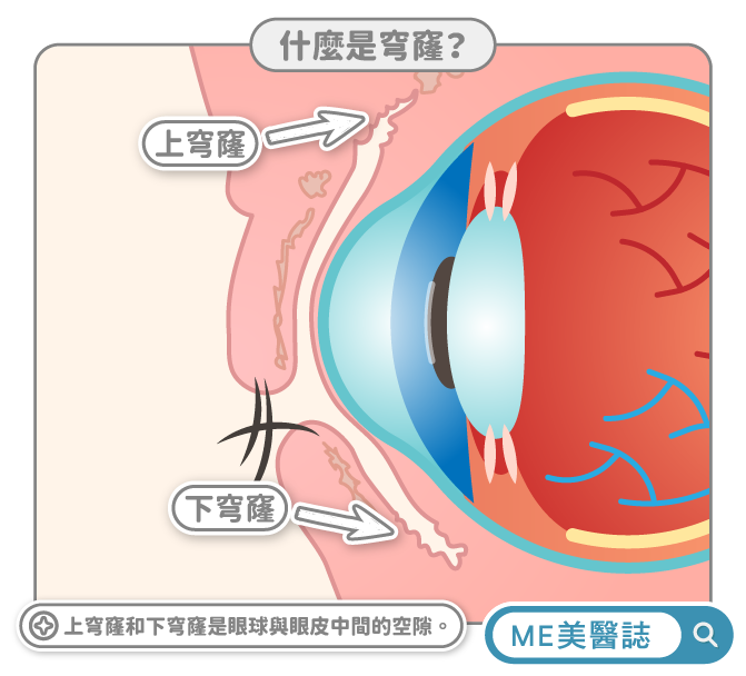 眼睛穹窿