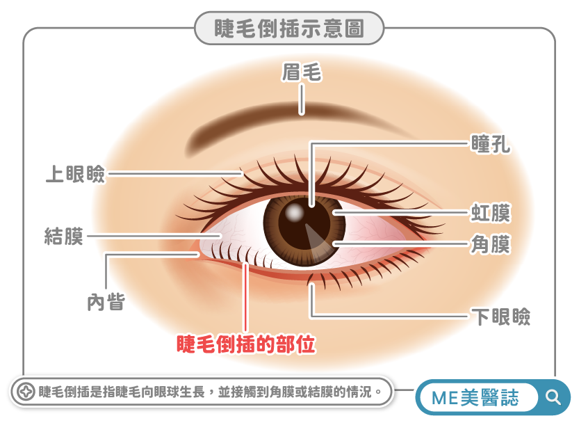 睫毛倒插