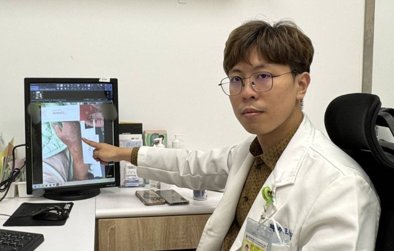 魚刺傷右手腫近2倍大 高雄秀傳及時救治讓患者免於截肢