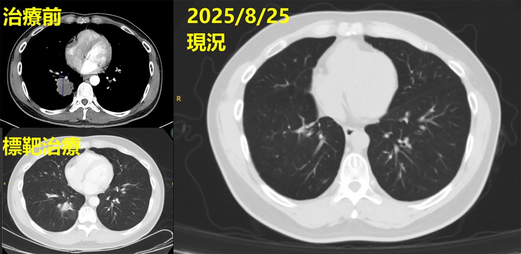 腦瘤竟是肺腺癌轉移-整合治療成功返回職場-彰基籲早發現治癒率高