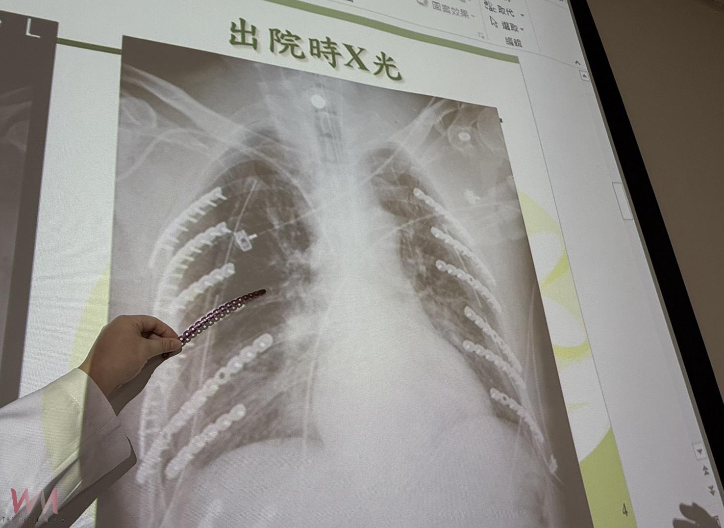 雙側肋骨遭工具車擠壓變形　14根鈦合金固定肋骨讓「鋼鐵人」重生 - https://www.watchmedia01.com