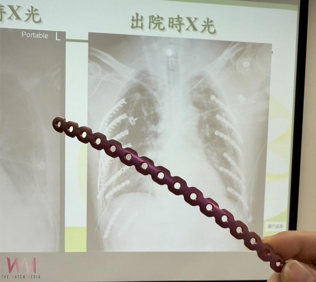 雙側肋骨遭工具車擠壓變形　14根鈦合金固定肋骨讓「鋼鐵人」重生 - https://www.watchmedia01.com