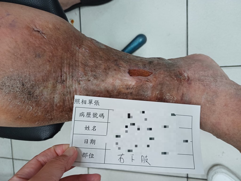 足踝傷口潰爛10多年-竟是靜脈瓣膜閉鎖不全