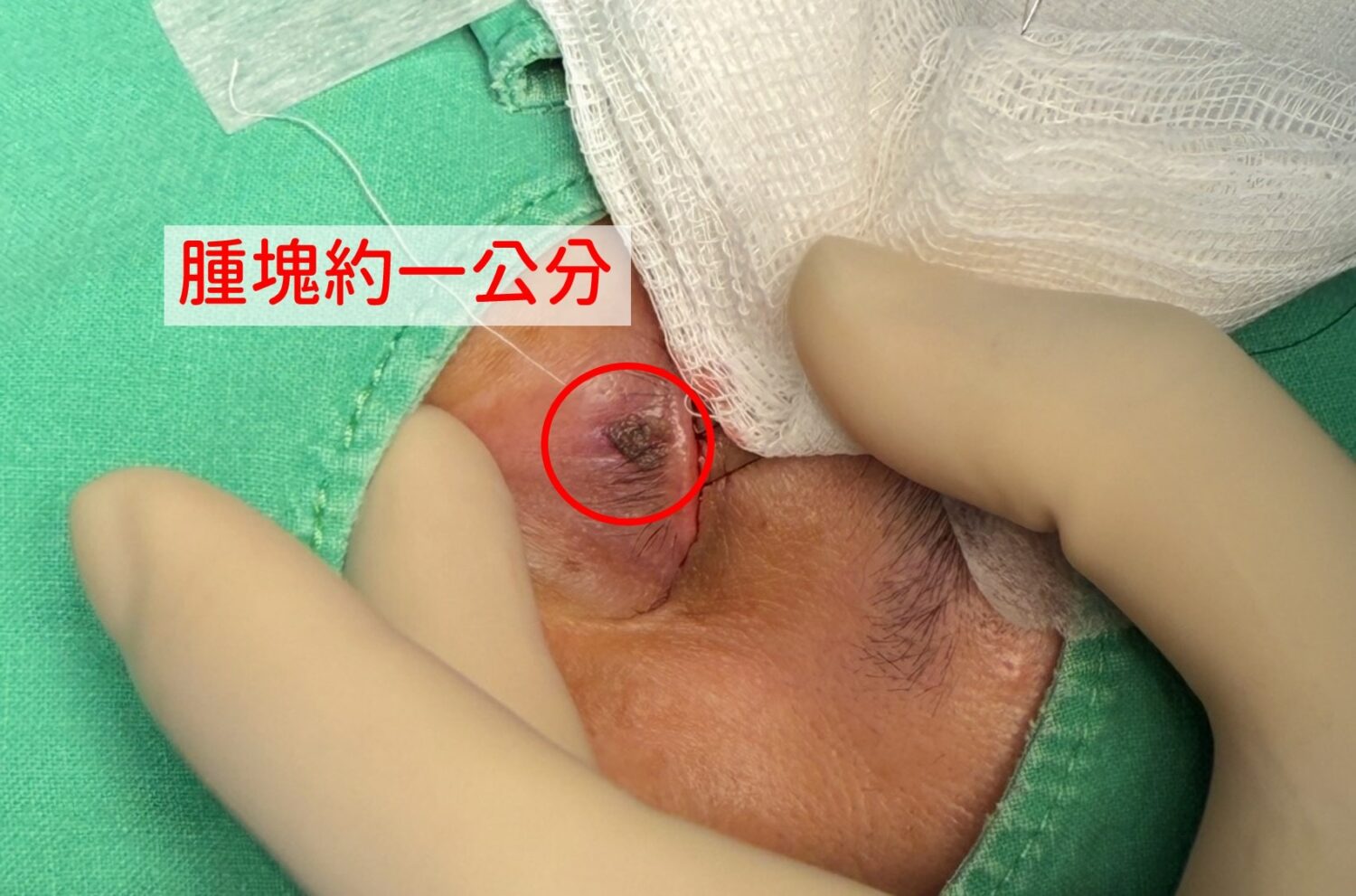 中國醫藥大學新竹附設醫院整形外科主任曾文楷指出，眼周腫塊外觀雖小，但可能潛藏惡性風險，應及早就醫診斷並接受精細手術治療。（圖/記者張家燁翻攝）
