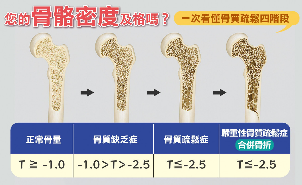 骨質疏鬆四階段