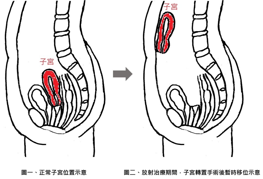全台首例子宮轉置手術! 她23歲直腸癌「暫移子宮」保住生育力 194 全台首例子宮轉置手術! 她23歲直腸癌「暫移子宮」保住生育力 193