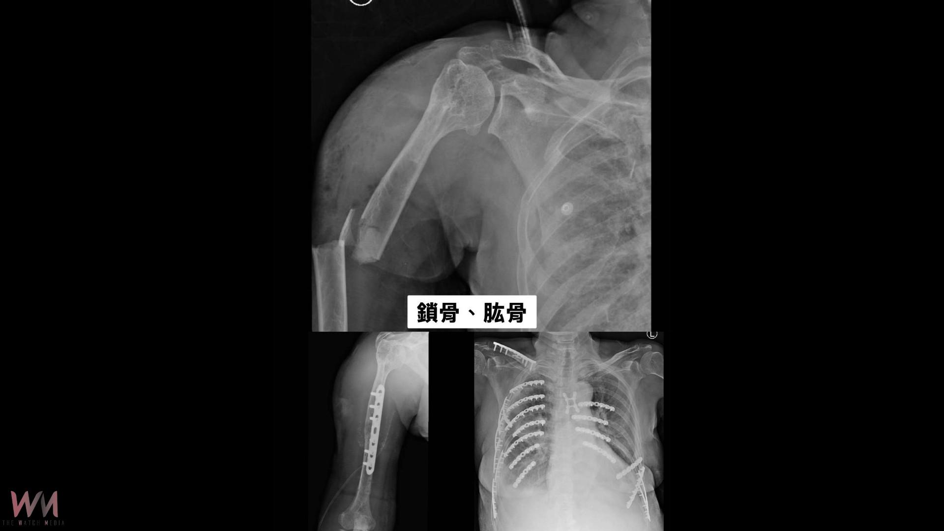 (有影片)/「奇蹟病人」70歲婦車禍骨碎如拼圖 7次手術奇蹟救回一命 - https://www.watchmedia01.com