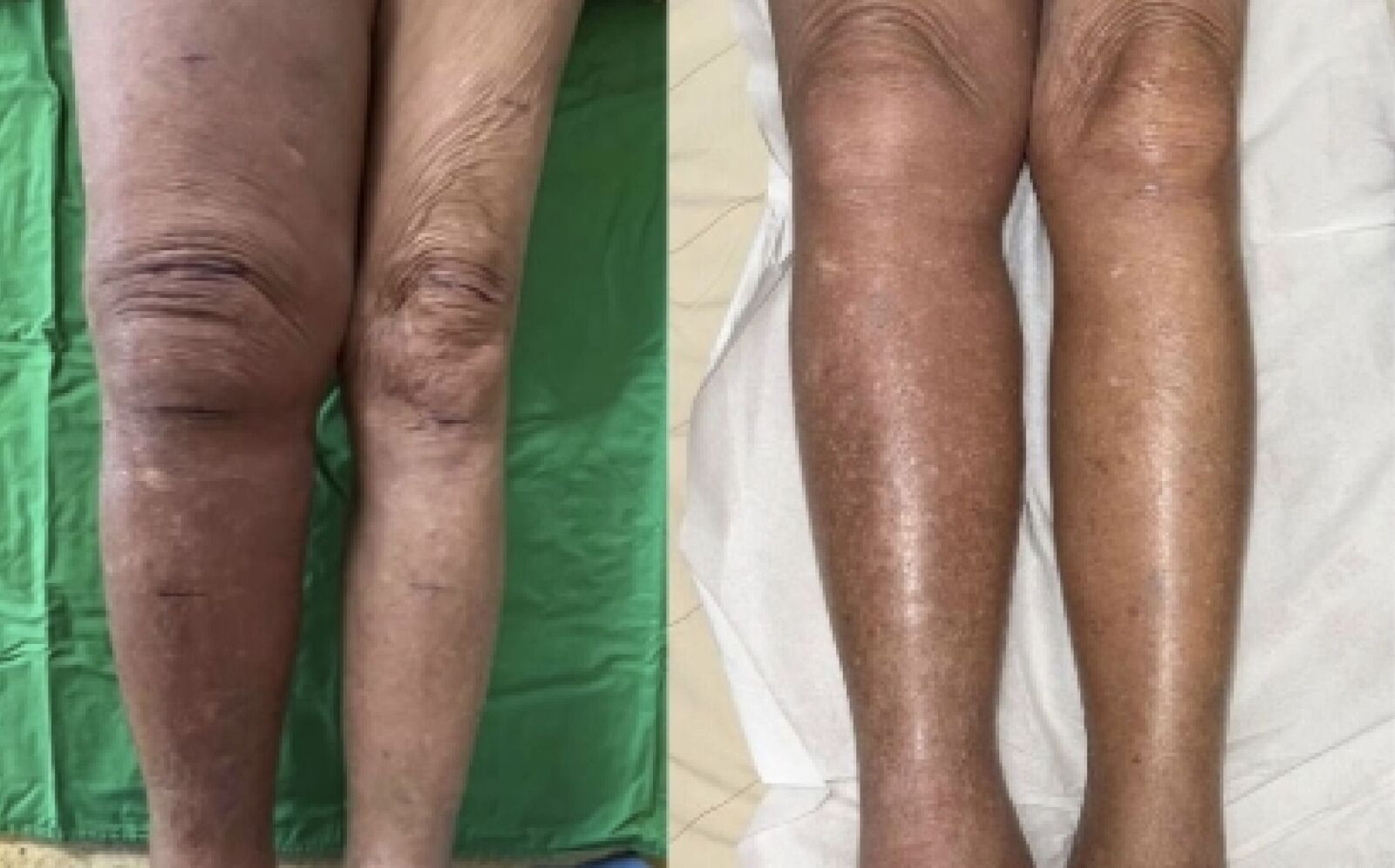她「一腳水腫3倍大」險長期臥床 醫神手用比髮細縫線吻合血管拆彈 186 她「一腳水腫3倍大」險長期臥床 醫神手用比髮細縫線吻合血管拆彈 185