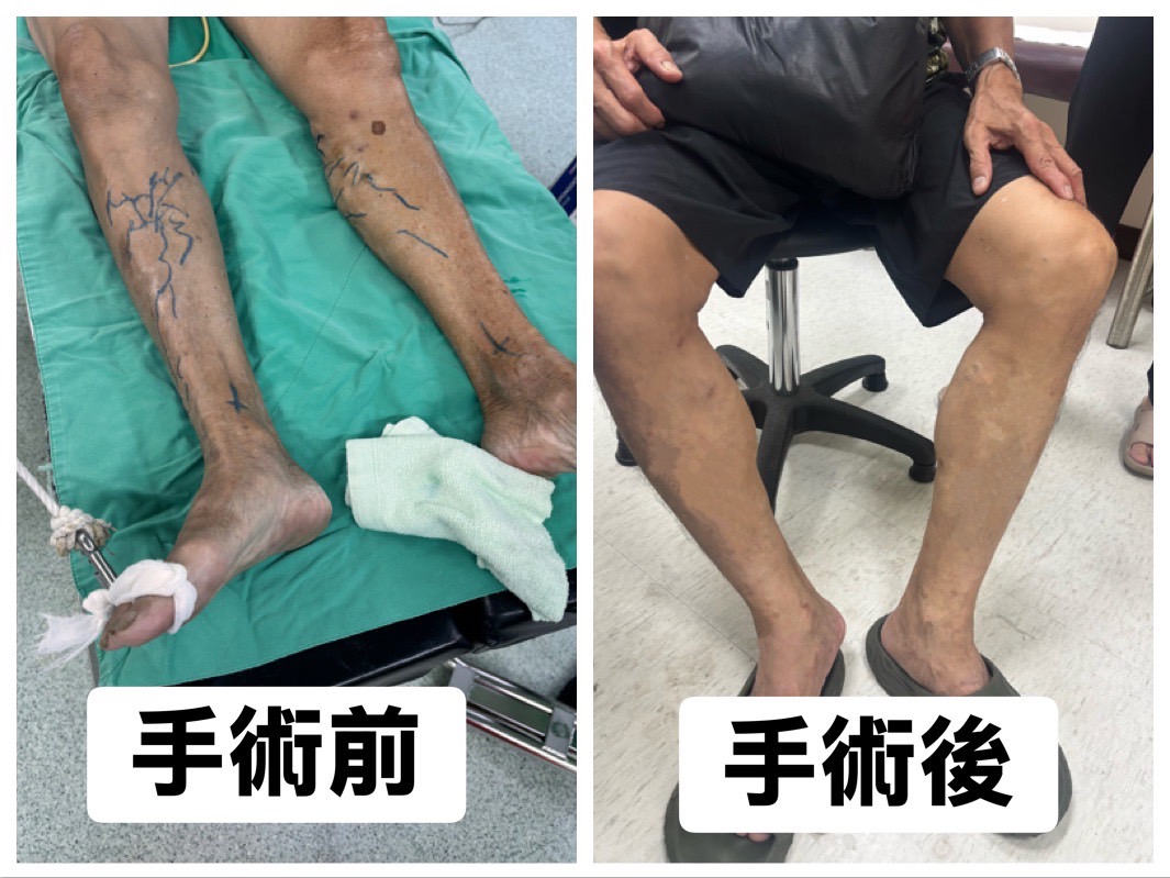 嘉義榮民醫院心臟外科林伯翰醫師,以雷射手術治療腳靜脈曲張,術後幾乎無明顯傷口疼痛感,隔日即能穿著醫療級彈性襪出院。(圖/嘉義榮民醫院提供)