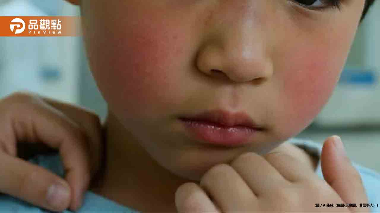 日本爆發蘋果病!5歲童遊日返台「臉頰紅如巴掌印」