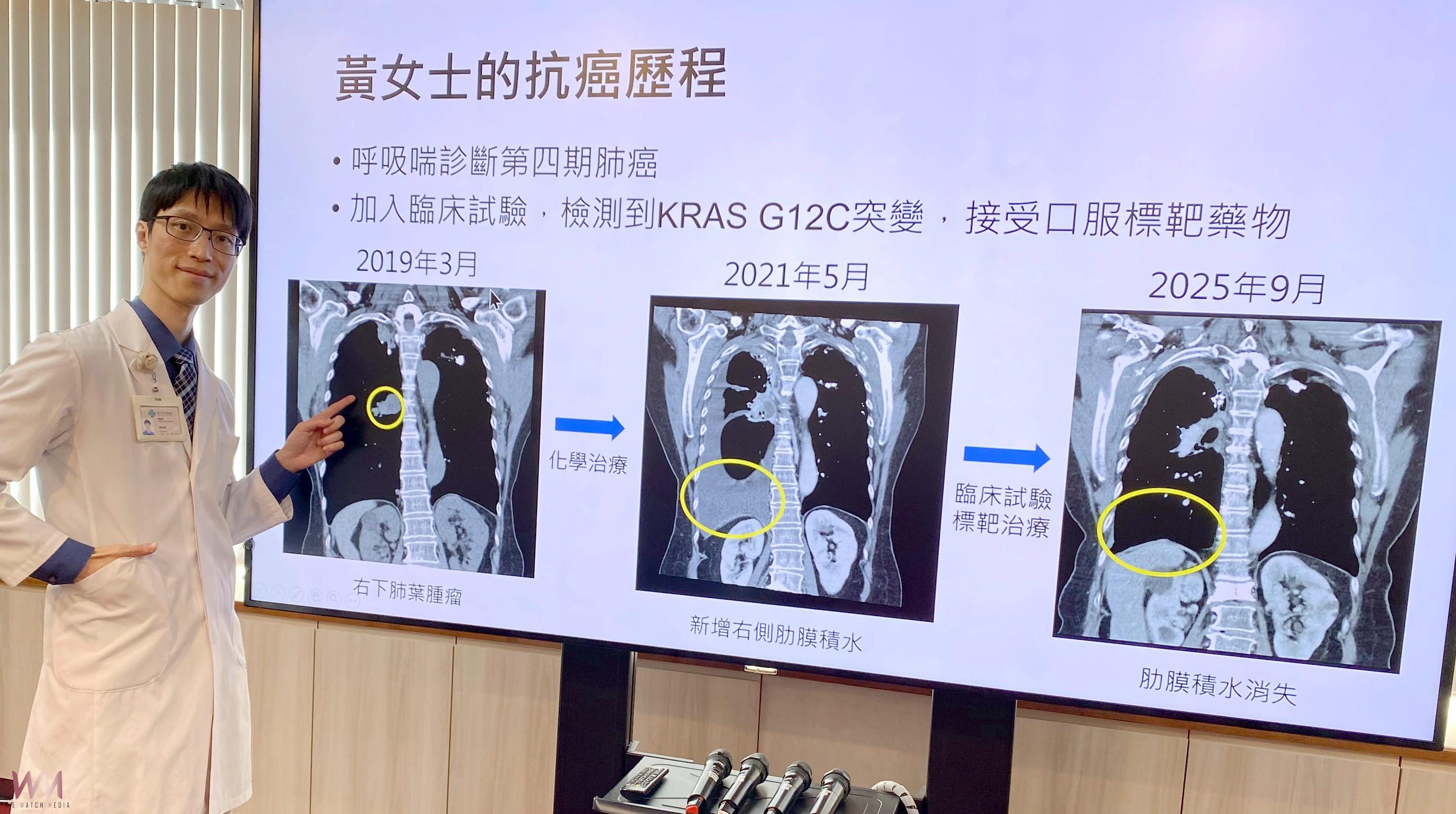 精準醫療改寫肺癌命運 四期病人存活逾6年 扭轉絕望為希望 - https://www.watchmedia01.com