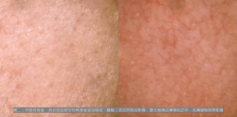 冬天洗臉越洗越乾？宋奉宜醫師：停止「熱水虐膚」，冷水才是修復敏感肌的關鍵