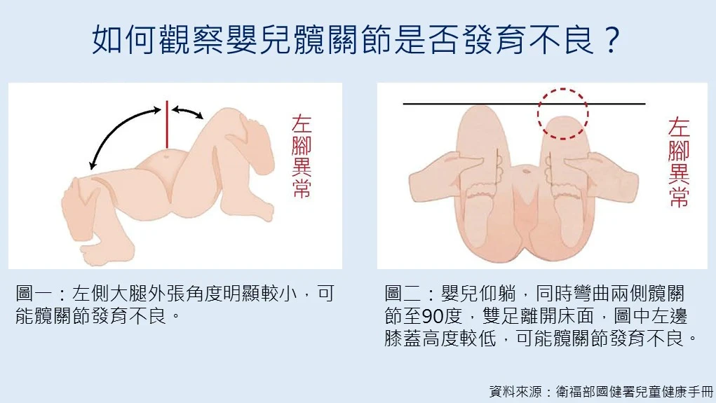 2招判斷髖關節異常