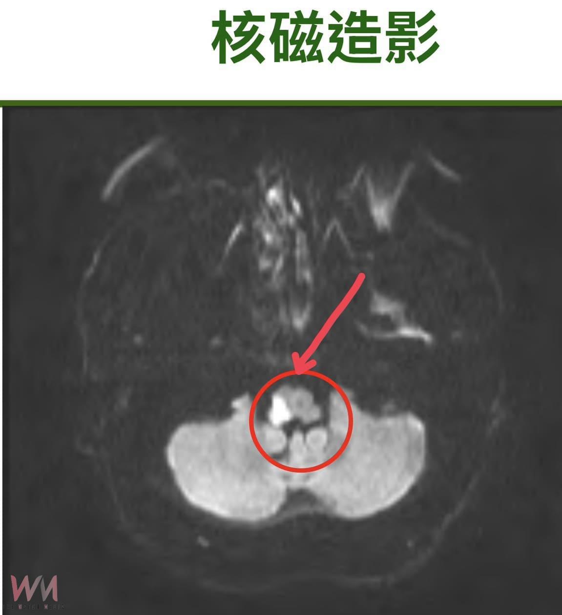 走路突然頭暈走不穩 檢查竟是腦幹中風 接受「一站式治療」數月病況穩定出院 - https://www.watchmedia01.com