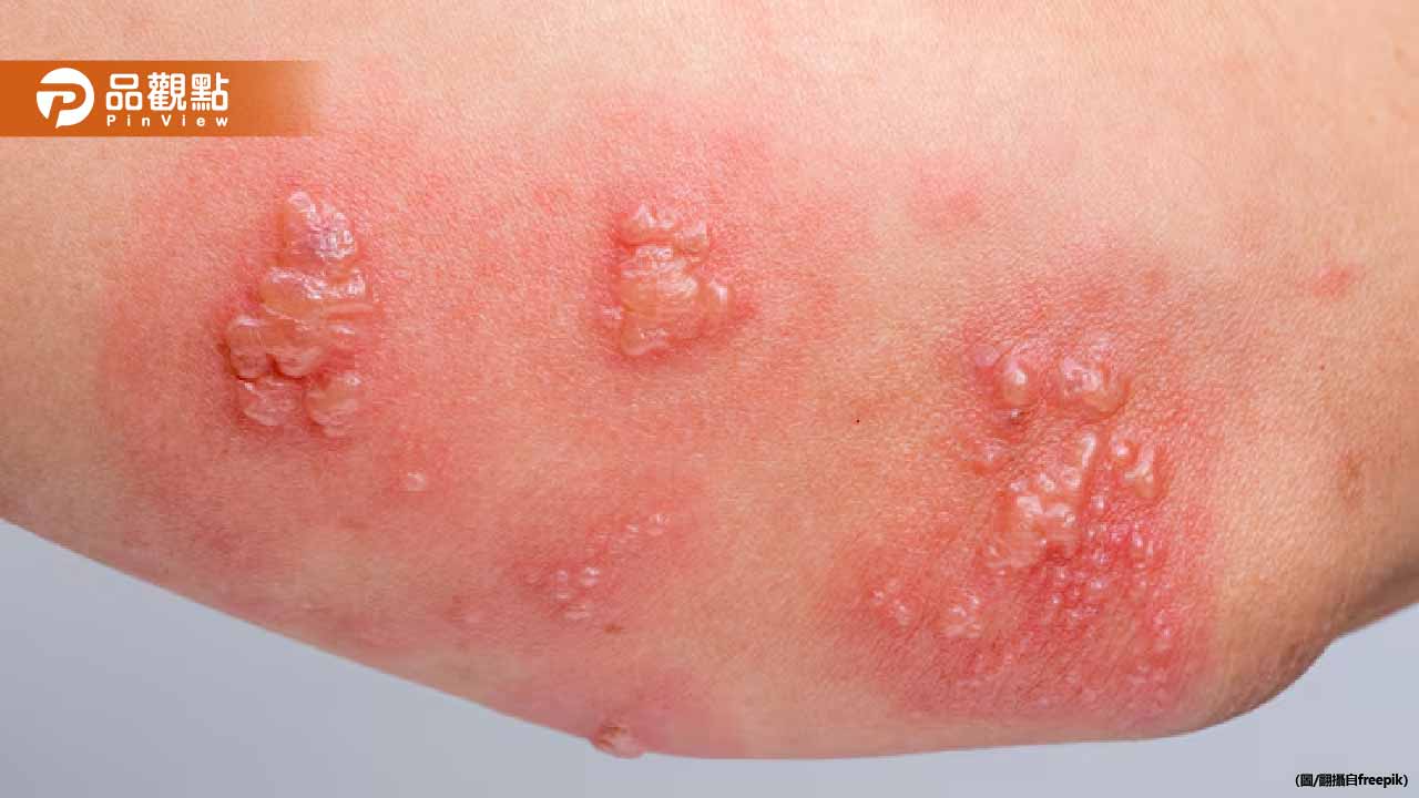 帶狀皰疹痛不欲生!醫曝高危險群:這些人最容易中招
