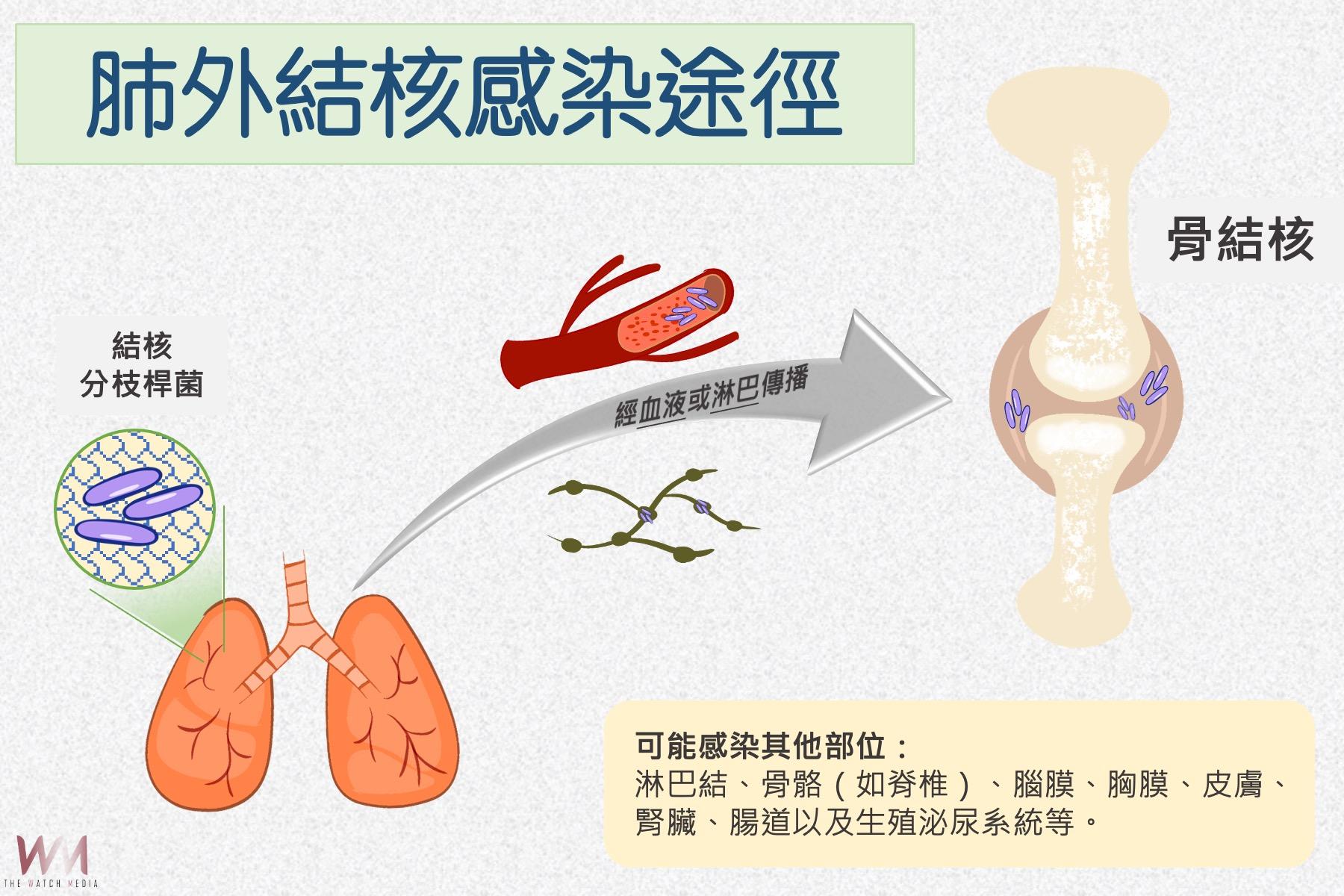 結核菌侵襲膝蓋腫痛難熬 台中慈濟醫院團隊救膝關節 - https://www.watchmedia01.com