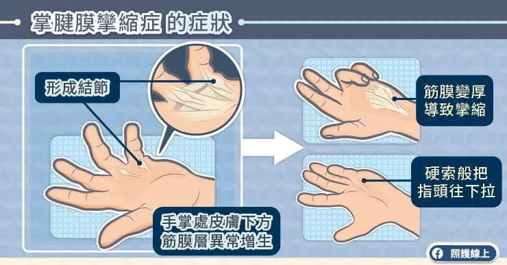 掌腱膜攣縮症的症狀