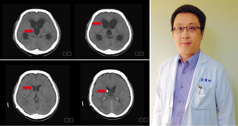 頭部外傷後意識不清嗜睡 留意水腦症 民生醫院團隊手術搶救 術後恢復意識重返職場