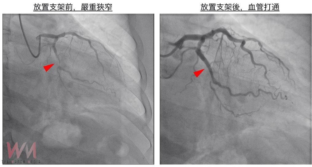 解除頑固型高血壓心臟未爆彈 立體定位神經消融術結合可吸收支架 保留血管彈性 - https://www.watchmedia01.com