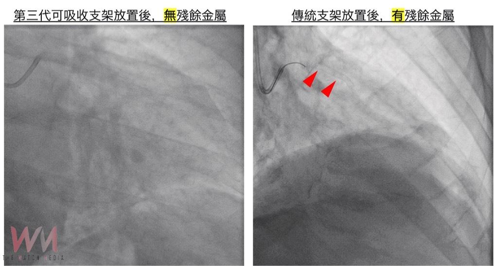 解除頑固型高血壓心臟未爆彈 立體定位神經消融術結合可吸收支架 保留血管彈性 - https://www.watchmedia01.com