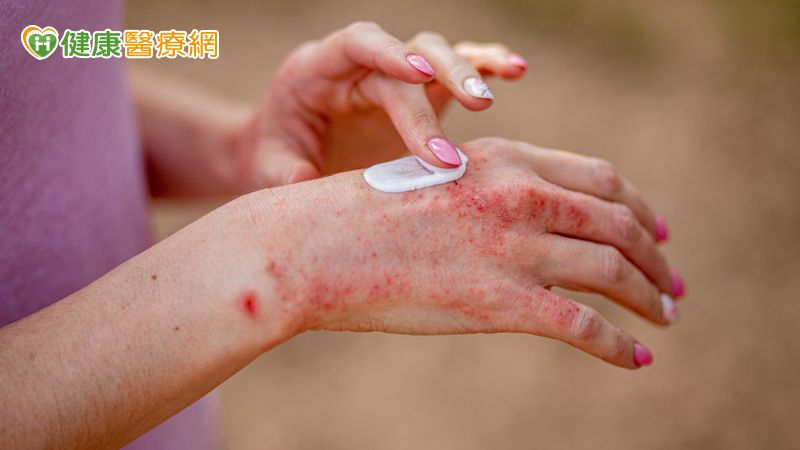 異位性皮膚炎怎麼用藥和吃穿?醫師一一告訴你