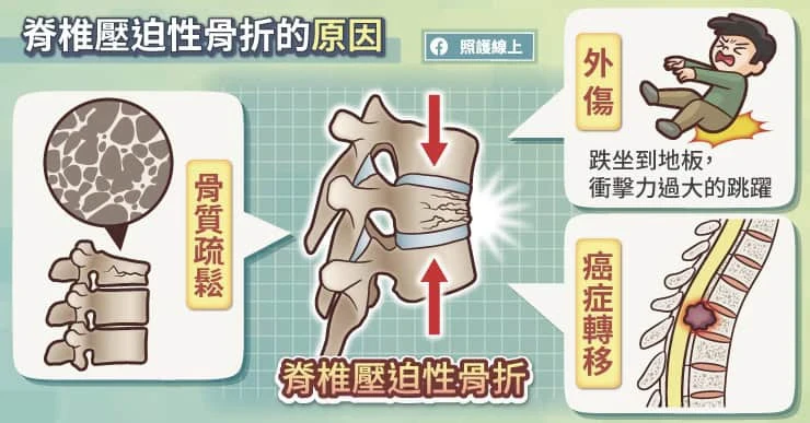 脊椎壓迫性骨折的原因
