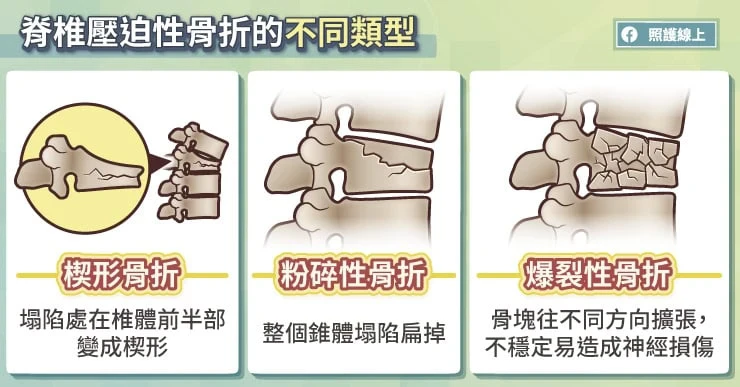 脊椎壓迫性骨折的不同類型