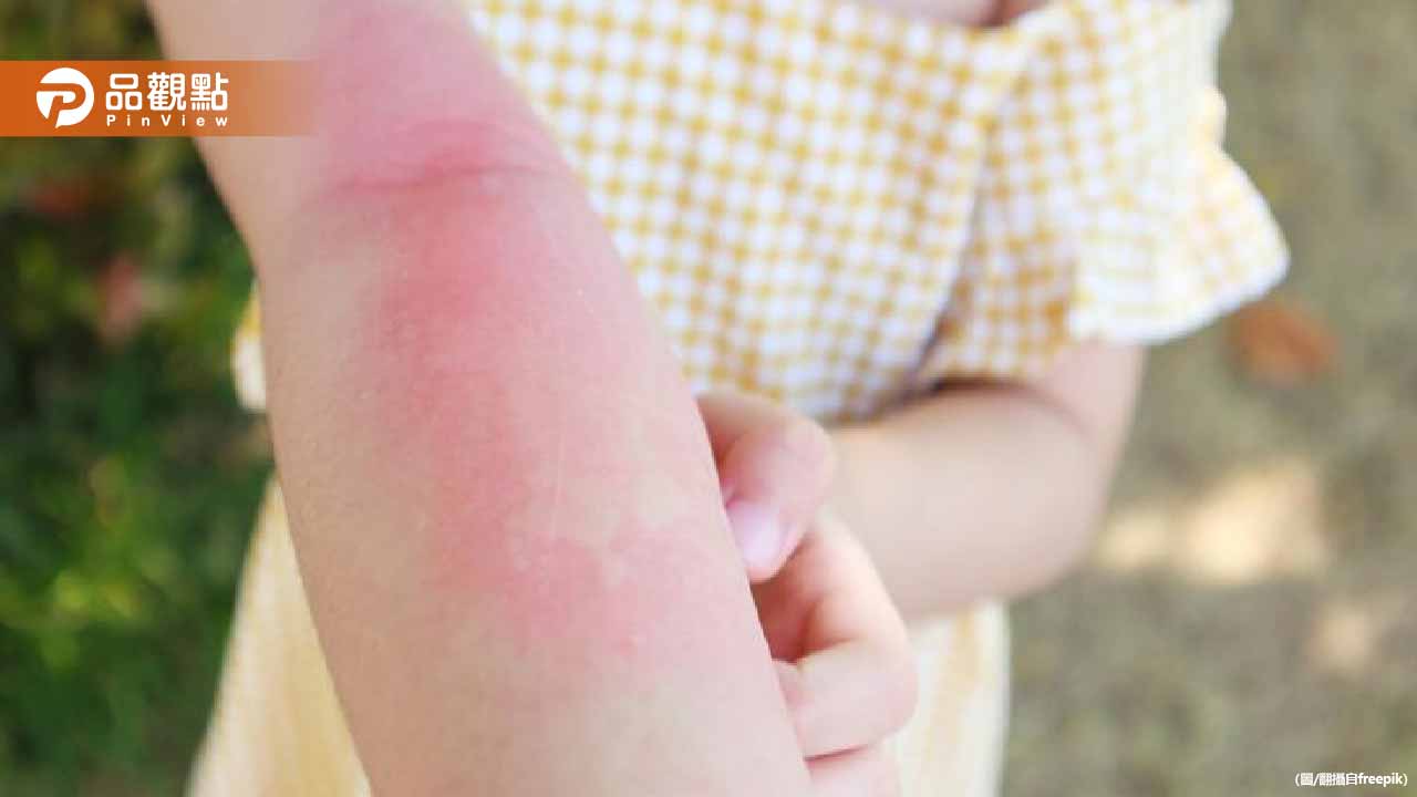 4歲女童染梅毒全身紅疹確診二期感染！竟是阿嬤用口餵孫女