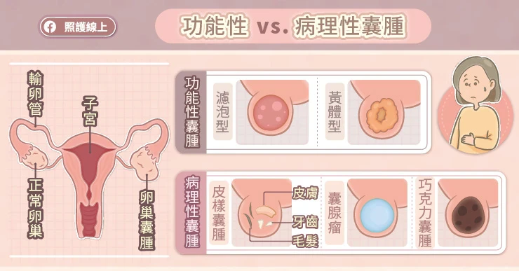 卵巢囊腫的類型