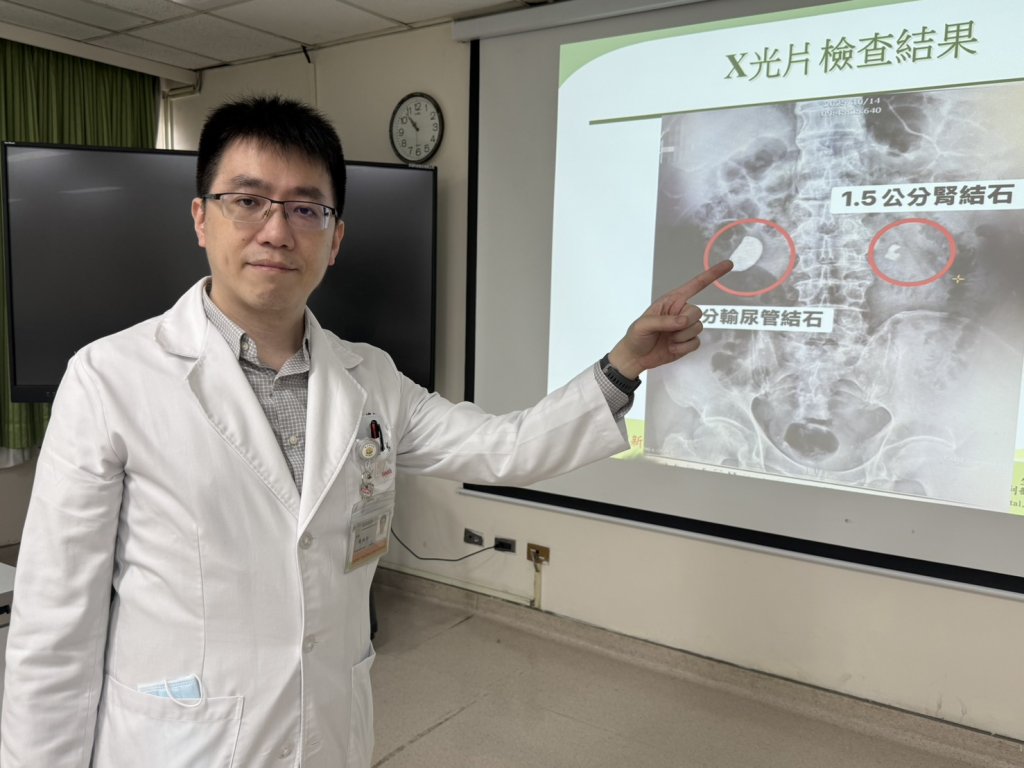 他腰痠血尿就醫-驚!右輸尿與左腎赫見大結石