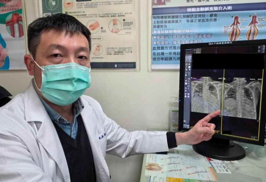 流感重症險奪命！大千葉克膜團隊緊急搶救助脫離險境