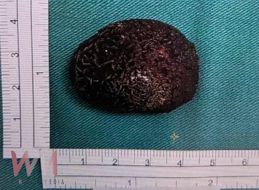 驚!男腰痠血尿就醫 右輸尿與左腎赫見大結石 緊急取石手術、震波碎石治療 - https://www.watchmedia01.com