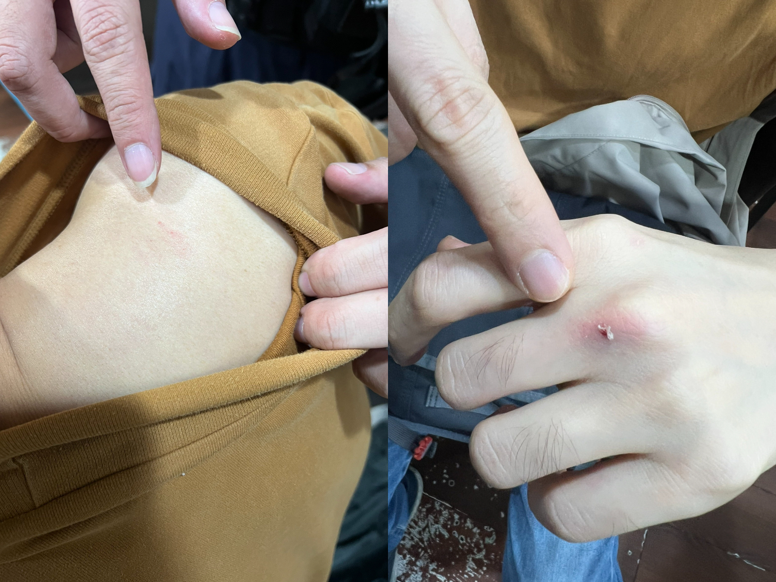 遭攻擊的陳男因躲避不及,導致肩膀及手臂嚴重瘀青,手指關節處亦有多處擦傷。