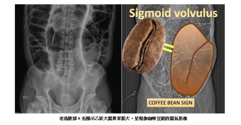 七旬老翁腹脹一週未排便 惡化腹痛就醫竟是大腸打結險喪命