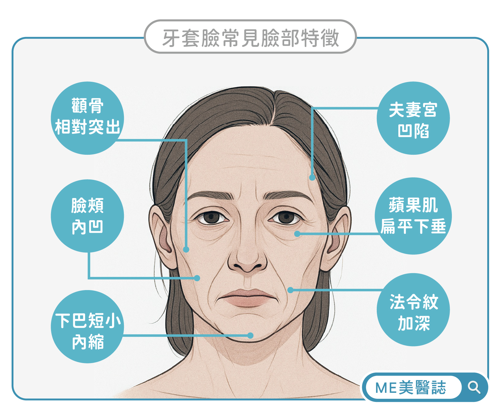牙套臉